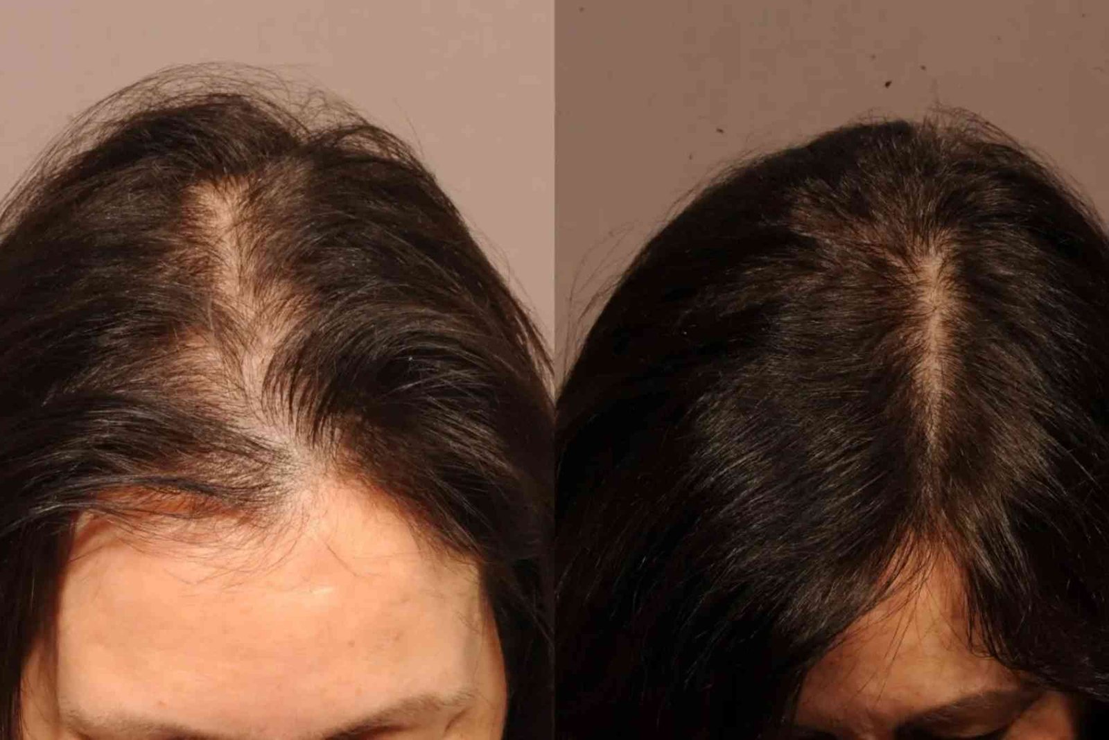 Best Hair Transplat Turkey