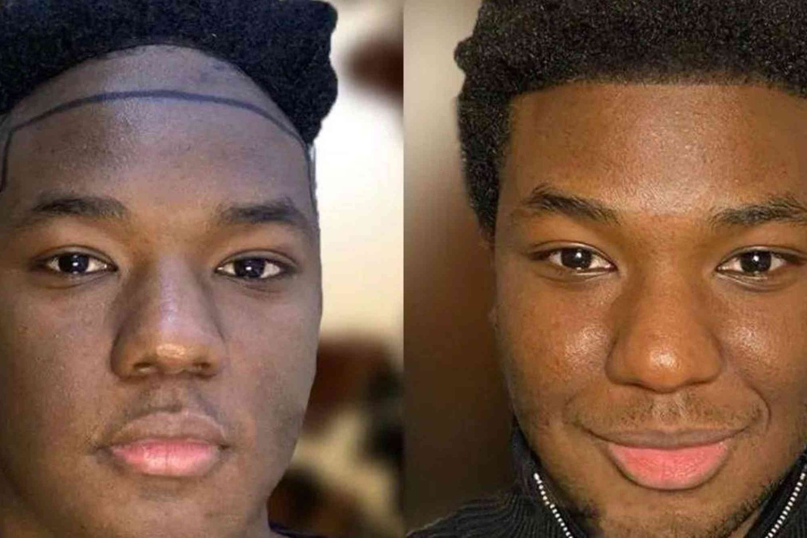 Hair Transplant Turkey