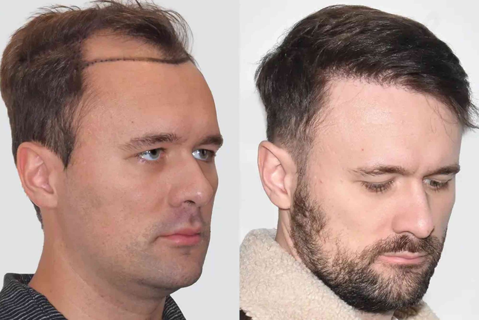 Best Hair Transplat Turkey